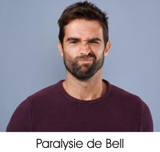 (Illustration d'un cas de paralysie de Bell)